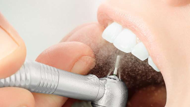 dental filling chagrin falls