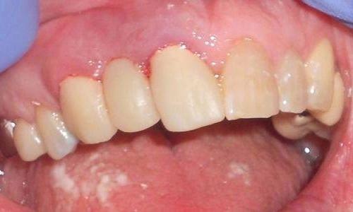 Repaired teeth | Chagrin Family Dental Care in Chagrin Falls, OH