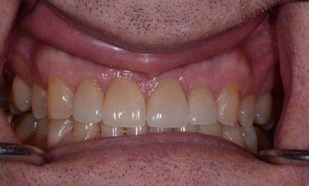 After crowns | Chagrin Family Dental Care in Chagrin Falls, OH