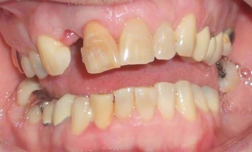 Missing and rotting teeth | Chagrin Family Dental Care in Chagrin Falls, OH