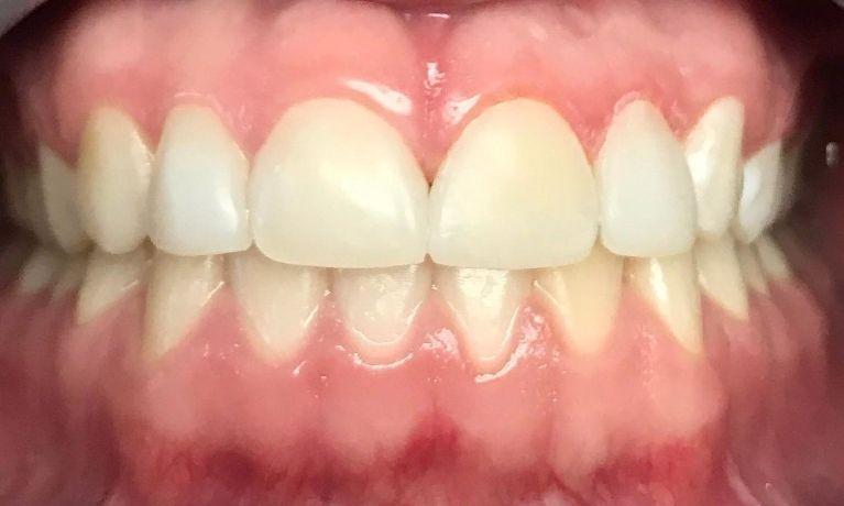 Gaps fixed in front teeth | Chagrin Family Dental Care in Chagrin Falls, OH