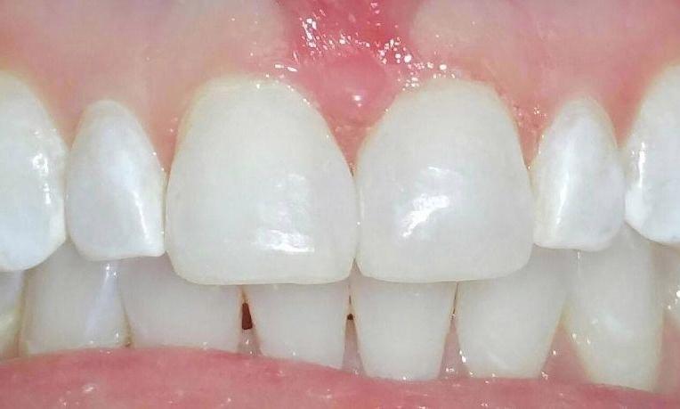 Bonding front teeth Chagrin Family Dental Care in Chagrin Falls, OH