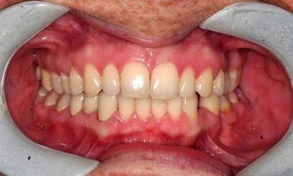 after porcelain bridge | Chagrin Family Dental Care in Chagrin Falls, OH