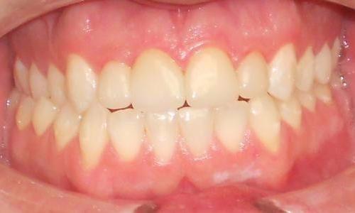Porcelain-Veneers-After-Image