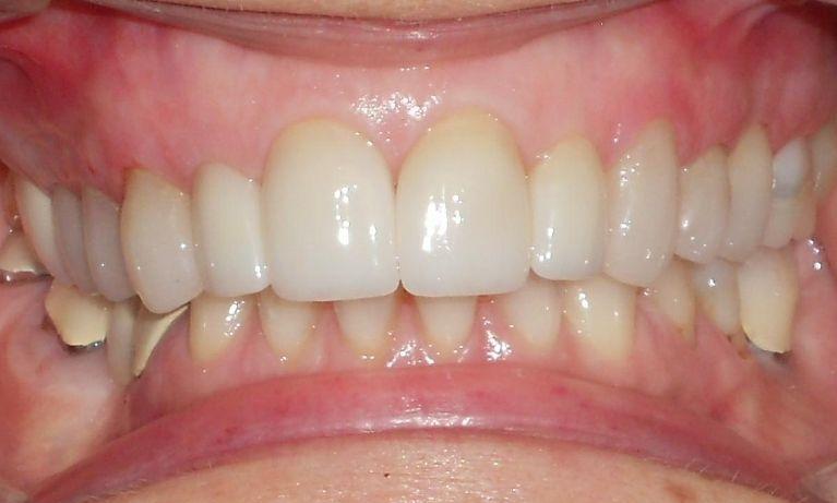 Corrected veneers | Chagrin Family Dental Care in Chagrin Falls, OH