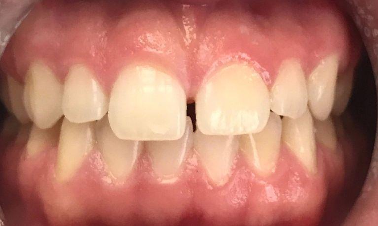 Gaps in front teeth | Chagrin Family Dental Care in Chagrin Falls, OH