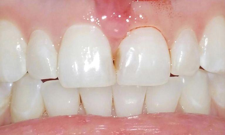 Stained front teeth Chagrin Family Dental Care in Chagrin Falls, OH