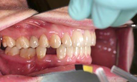 before bridge | Chagrin Family Dental Care in Chagrin Falls, OH