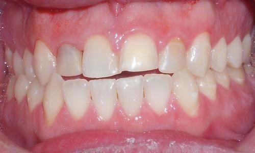 Porcelain-Veneers-Before-Image