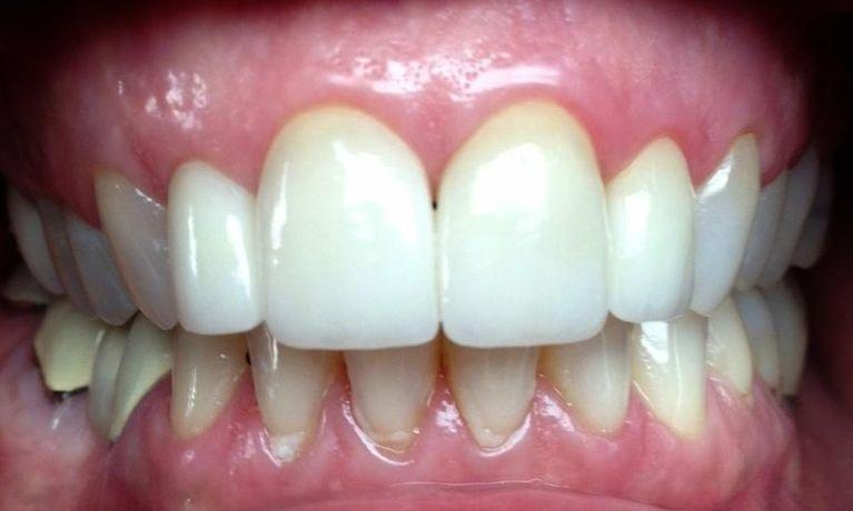 Before veneers | Chagrin Family Dental Care in Chagrin Falls, OH